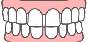 すきっ歯の治し方