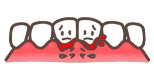 歯磨きで出血は要注意？