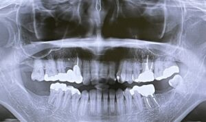 歯医者はレントゲン撮りすぎ？